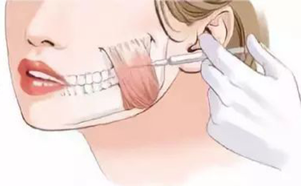 哪些小習慣會導致咬肌肥大？咬肌肥大怎么辦？