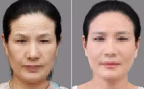 激光除皺有什么優(yōu)勢(shì)？