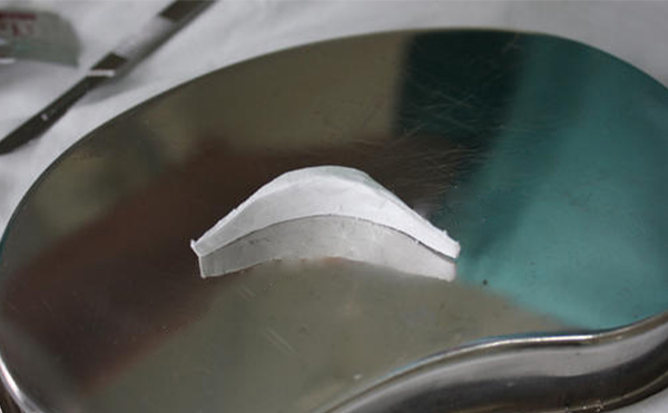 膨體豐下巴術(shù)后下巴的手感真實嗎?術(shù)后如何護理?