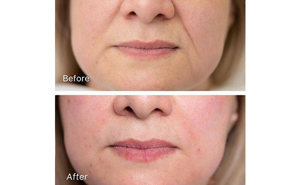 玻尿酸去法令紋安全嗎？