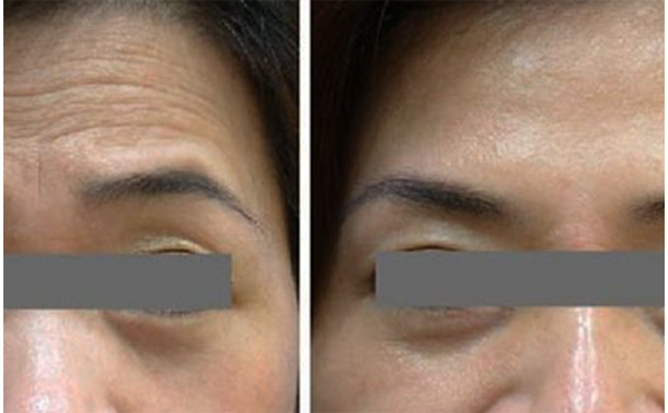 玻尿酸去抬頭紋能維持多久？