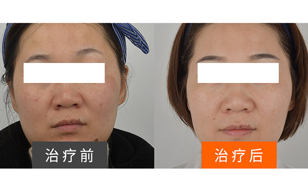 彩光嫩膚安全不安全？