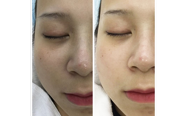 激光祛斑有哪些誤區(qū)？