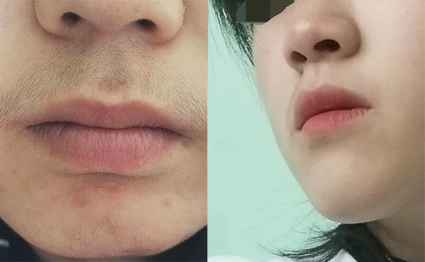 激光脫毛的效果怎么樣？