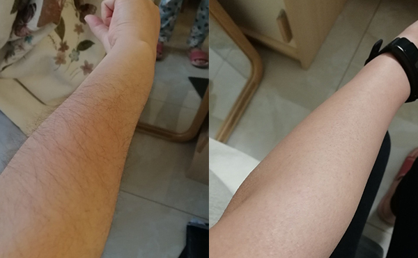 激光和光子脫毛的區(qū)別是什么?怎么區(qū)分?