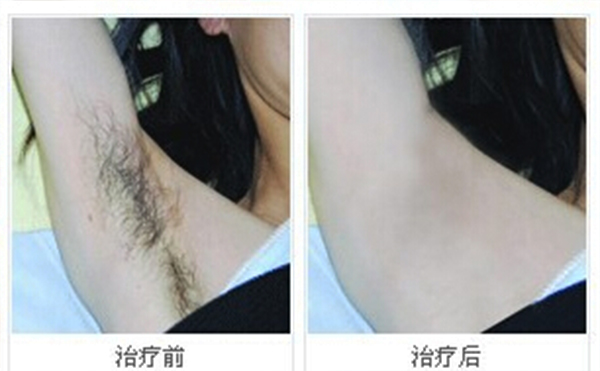 冰點脫腋毛安全嗎？