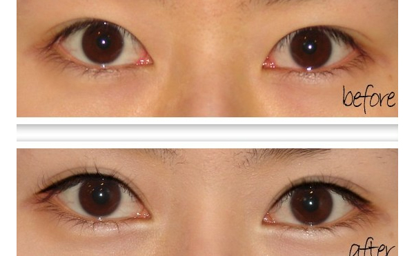 開眼角手術(shù)有什么原則？