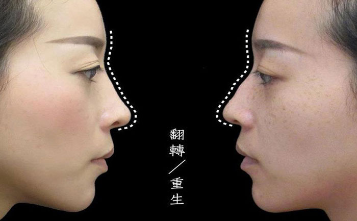 駝峰鼻矯正多少錢？駝峰鼻矯正有危險嗎？