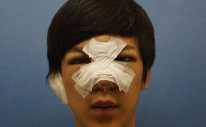 駝峰鼻矯正手術多少錢？駝峰鼻矯正有危險嗎？