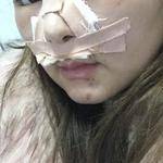 鼻基底整形案例對比3