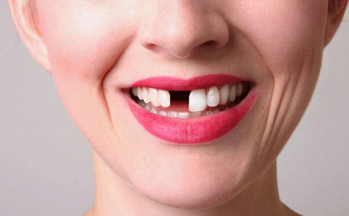 補(bǔ)門牙缺口大概多少錢？補(bǔ)門牙后一般能維持幾年？