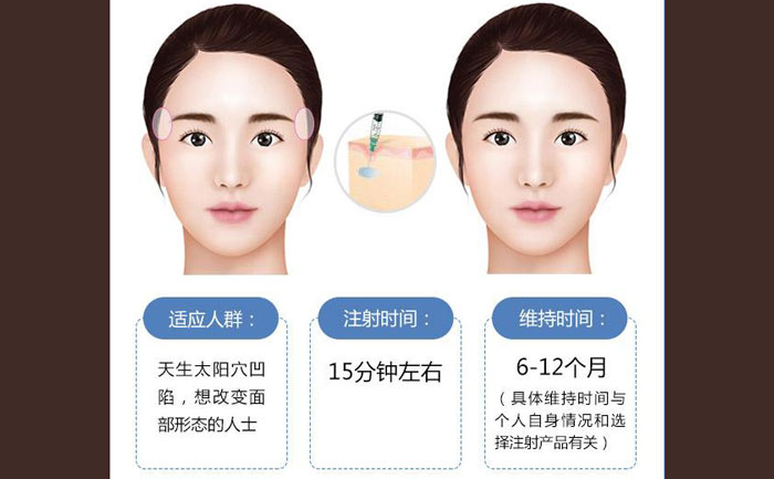 玻尿酸豐太陽穴一般幾支？