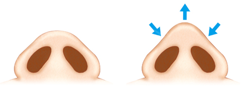 術后變成了朝天鼻