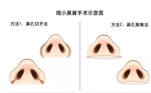 鼻頭鼻翼縮小