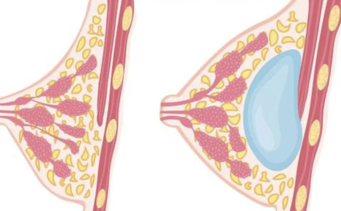 硅膠假體豐胸需要多少錢？硅膠假體豐胸可以保持多久？