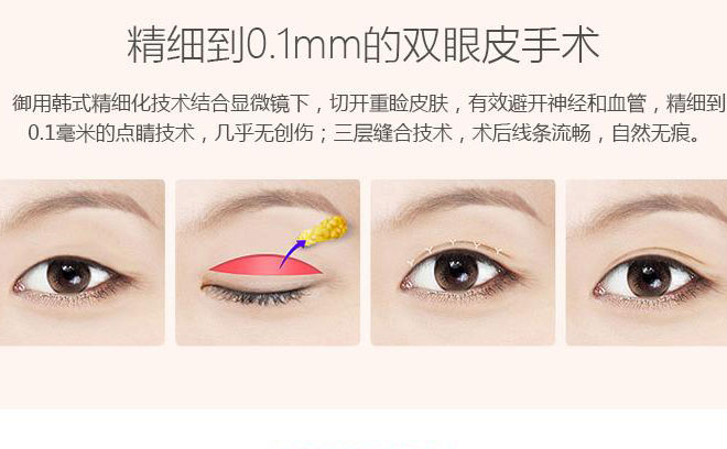 韓式三點雙眼皮一般要多少錢？