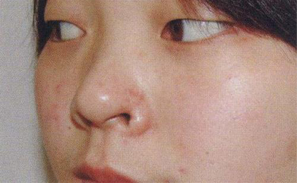 鼻翼缺損是怎么修復(fù)的？鼻翼缺損的修復(fù)效果怎么樣