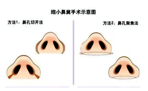  鼻翼縮小有后遺癥嗎？會不會反彈