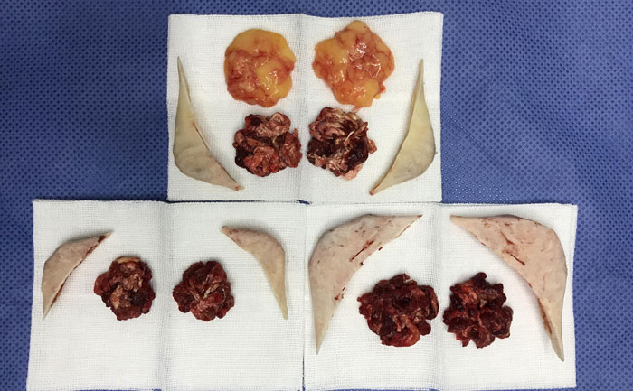 磨骨瘦臉費用多少錢？