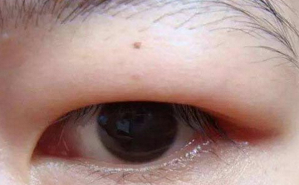 如何區(qū)分腫泡眼和眼球突出?術(shù)前檢查過(guò)程?