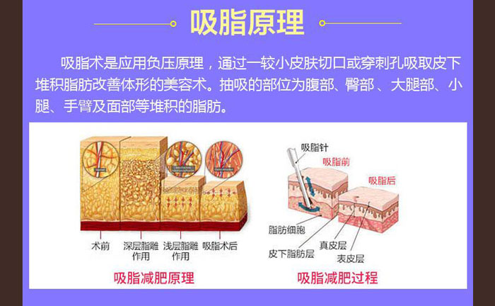 水動力吸脂效果好嗎？