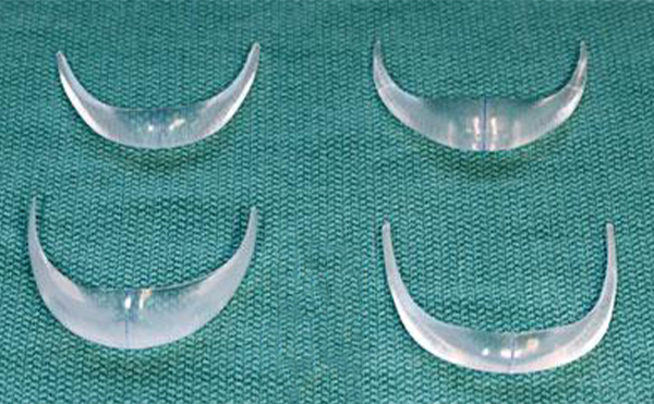 做了假體下巴幾天能消腫?時(shí)間久了假體會硬化嗎?