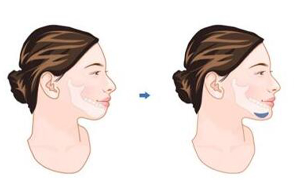 做假體墊下巴需要住院嗎?拆線疼不疼?