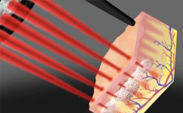 光子嫩膚和皮秒有什么區(qū)別?哪個(gè)好?