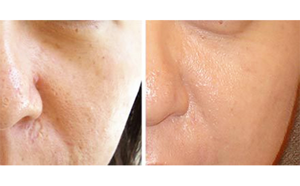 常見的酸有哪些?怎么選擇適合自己的?