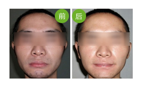 冰點面部脫毛值得做嗎？