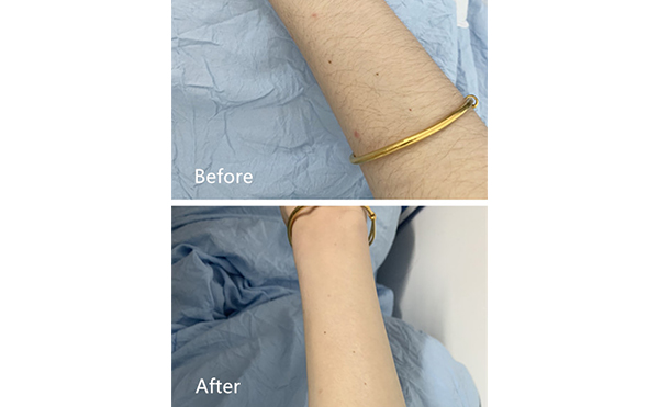 激光脫毛的影響因素有哪些？