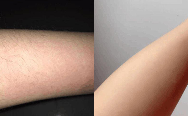 激光手臂脫毛安全嗎？