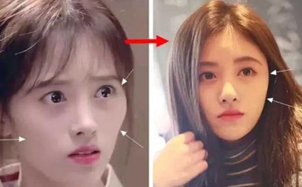 顴骨內(nèi)推術(shù)后護理工作