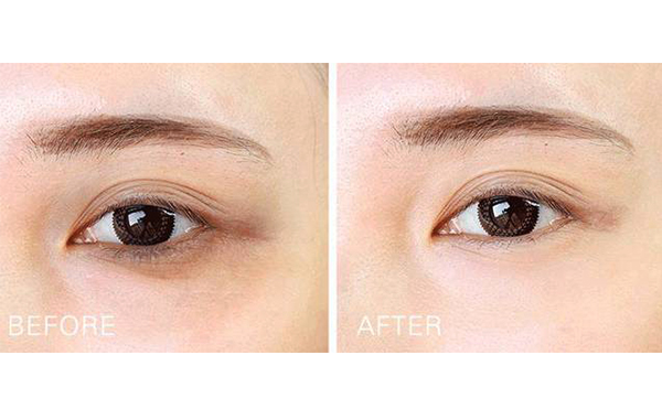 假性眼袋和真性眼袋的區(qū)別?假性眼袋怎么消除?