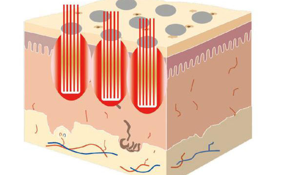 點(diǎn)陣激光祛斑后多久消失？