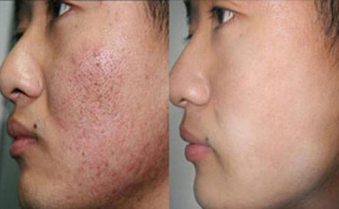 痘坑修復(fù)激光手術(shù)大概要多少錢？