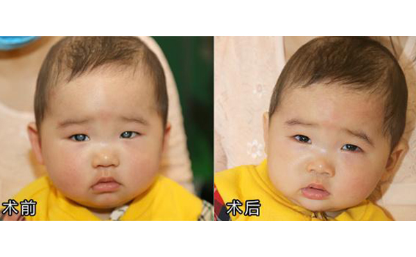 年齡小做眼瞼缺損矯正效果如何?術(shù)前術(shù)后有什么注意事項(xiàng)?