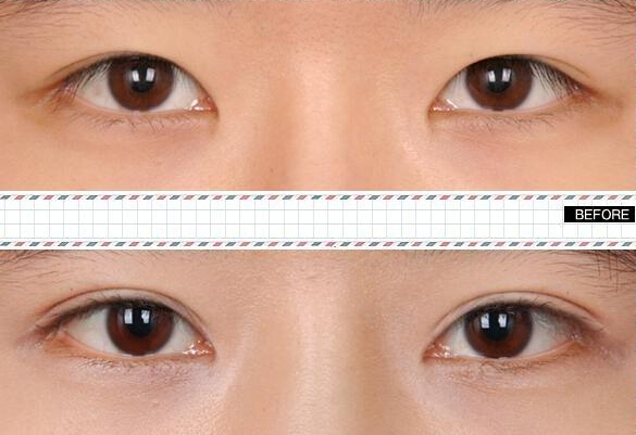 做雙眼皮價格是多少？哪種眼睛適合做雙眼皮呢?