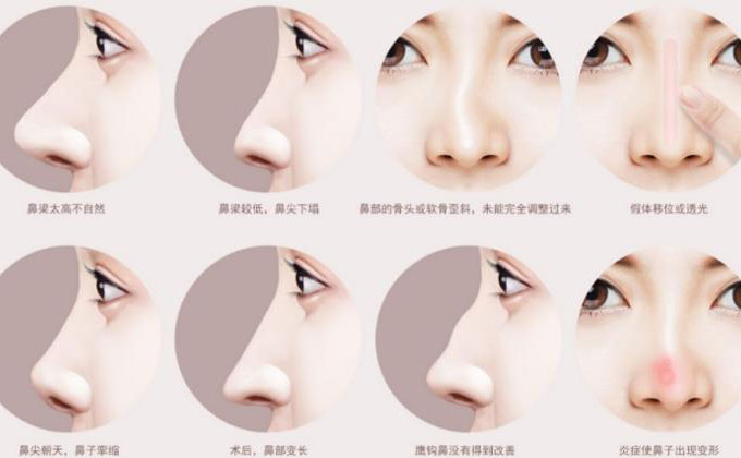 鼻尖整形大概多少錢？