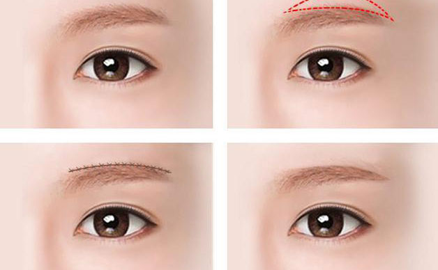 切眉除皺效果好嗎？