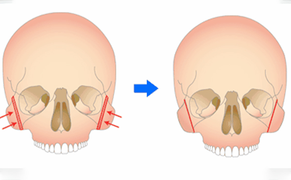 重慶藝星顴骨降低是怎么做的？術(shù)后要注意什么？