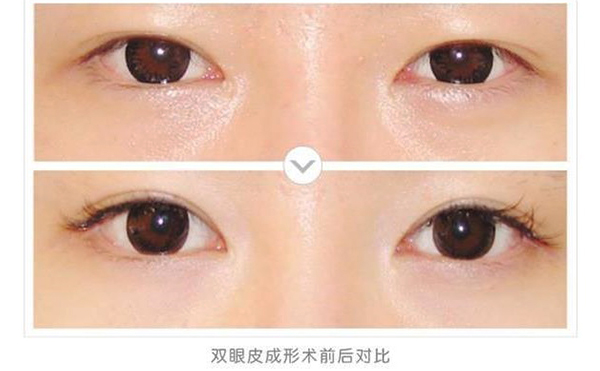 全切雙眼皮會(huì)越來(lái)越窄嗎?全切雙眼皮多久能恢復(fù)正常?