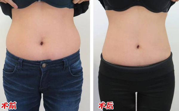 腹部吸脂效果如何？