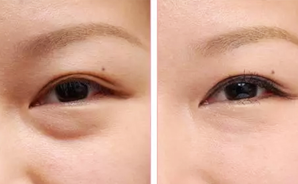 內(nèi)切去眼袋安全性怎么樣?內(nèi)切去眼袋會復發(fā)嗎?