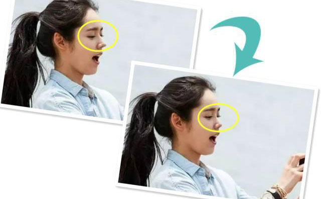 朝天鼻手術(shù)需要多少錢？