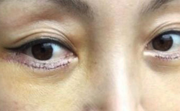 眼袋修復(fù)一般多少錢?眼袋修復(fù)術(shù)后怎么護理?