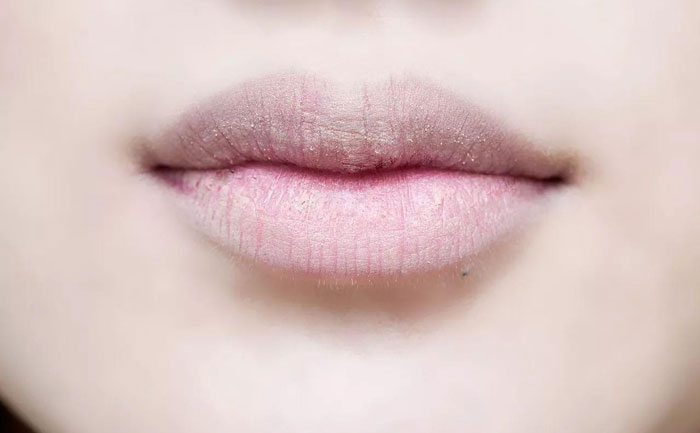 厚唇改薄多久完全恢復？