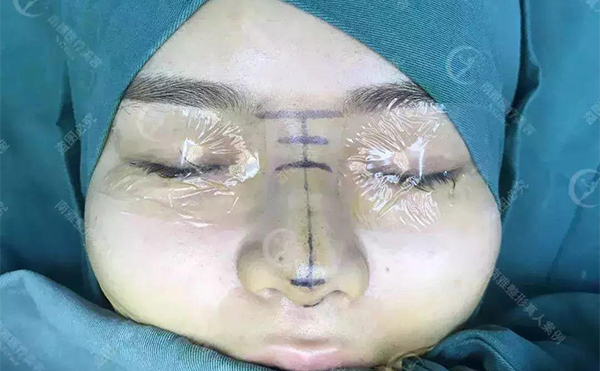 隆鼻術后多久能看到效果？