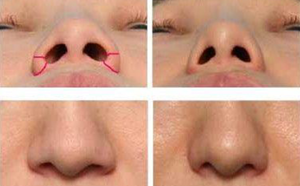 鼻翼縮小需要多少錢