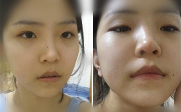 鼻翼缺損修復后和常人一樣嗎？